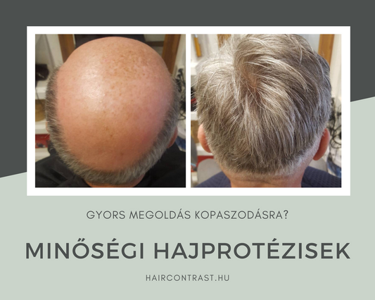 A férfi hajhullásról és a kezeléséről